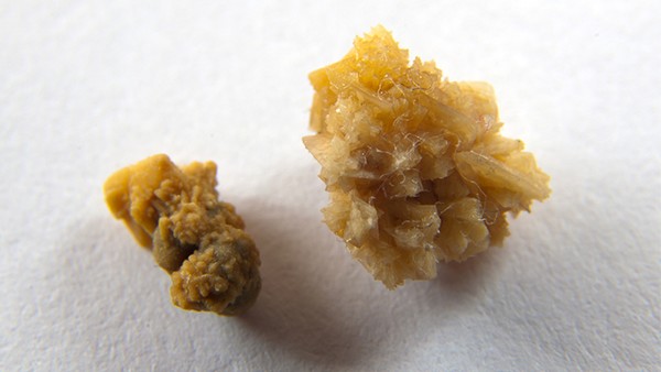 渐冻人早期症状有哪些